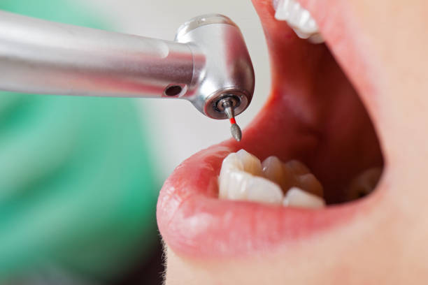 Best Emergency Dentist for Lost Fillings or Crowns in Humansville, MO